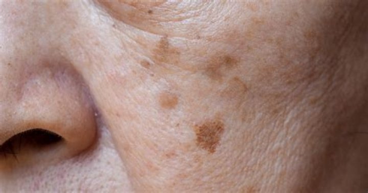 Are age spots raised?