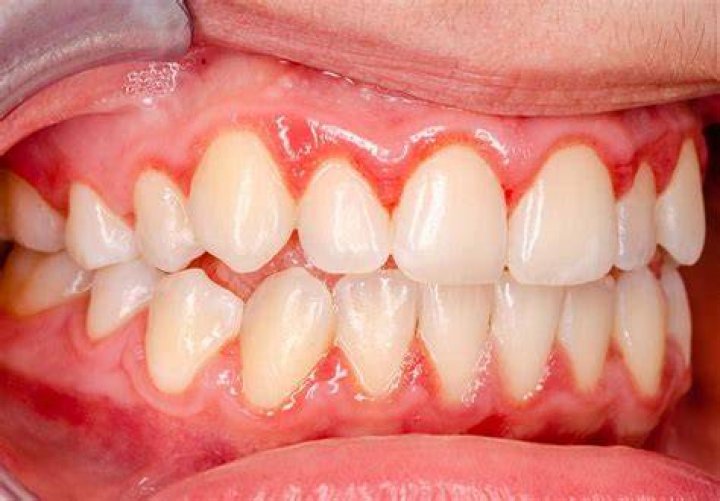 Can gingivitis be one spot?