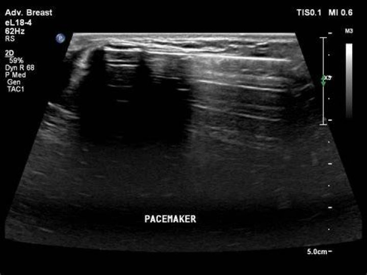 Can I have a breast ultrasound with a pacemaker?