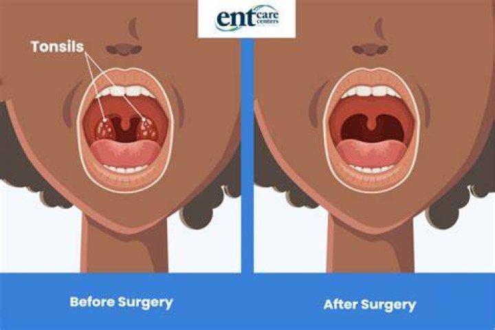 Can removing tonsils help with ear pain?