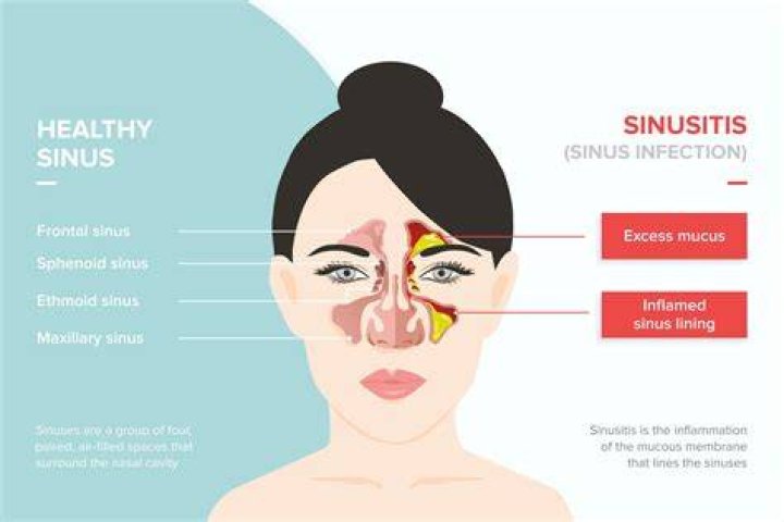 Can sinus rinses cause infection?