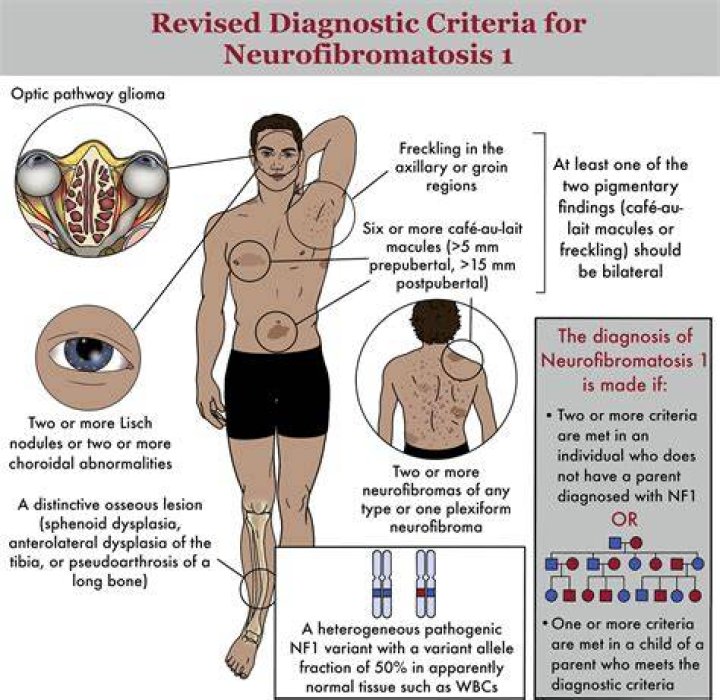 Can you have NF1 and not know it?