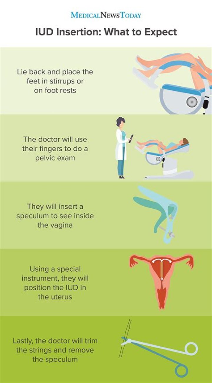 Can you lose weight after IUD removal?