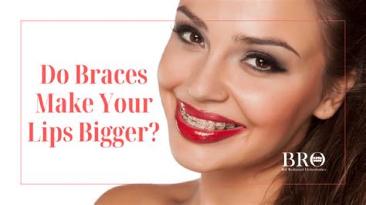 Do braces give you bigger lips?