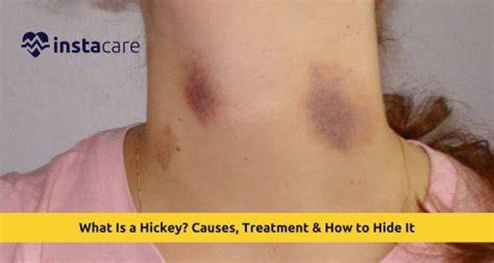 Do hickeys hurt when you touch them?