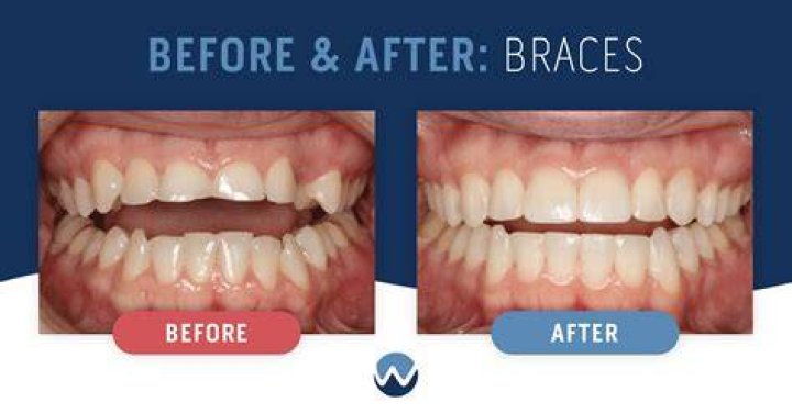 Do teeth get weak after braces?