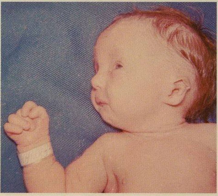 Do trisomy 18 babies kick?