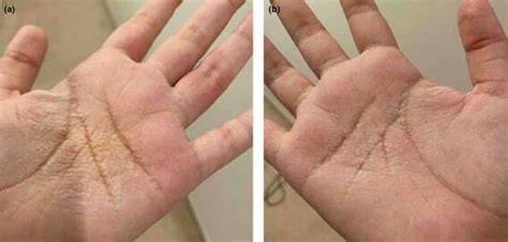 Does aquagenic wrinkling go away?