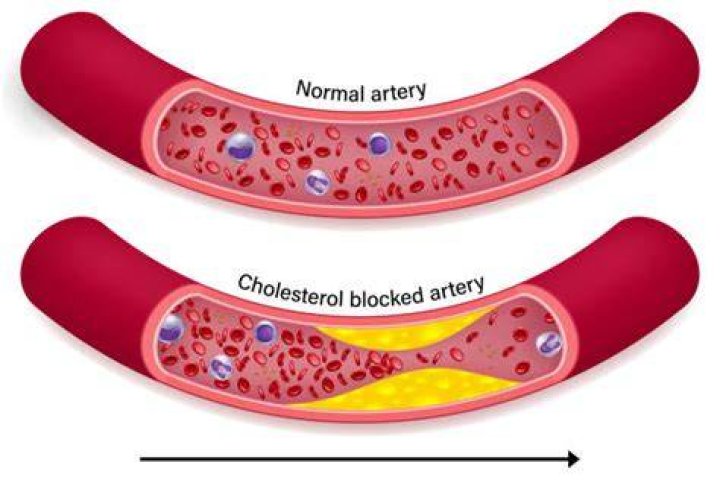 Does bacon clog arteries?