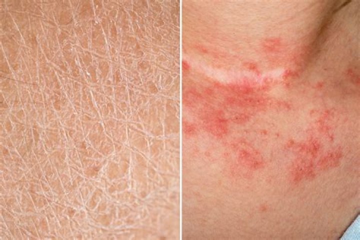 Does dry skin mean your having a boy or girl?