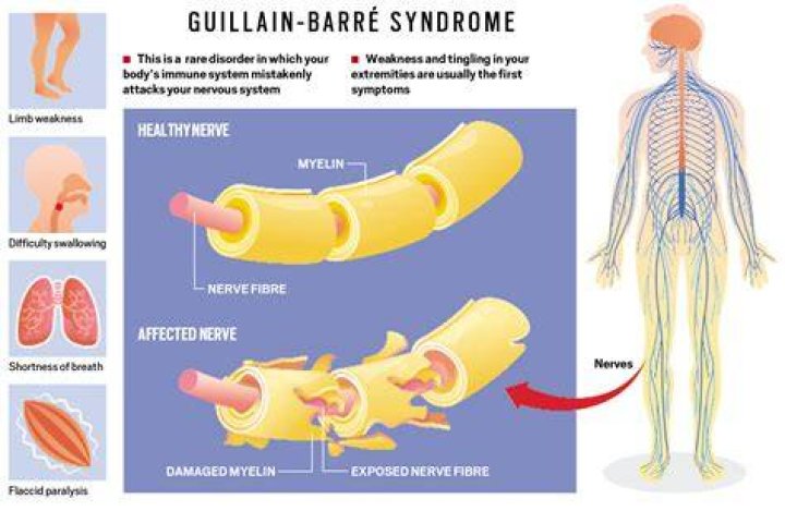 Does Guillain Barre cause brain lesions?
