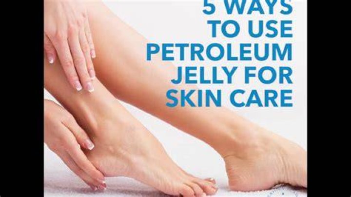 Does petroleum jelly help pimples?