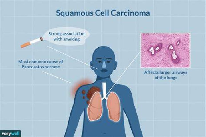 Does smoking cause squamous cell carcinoma?