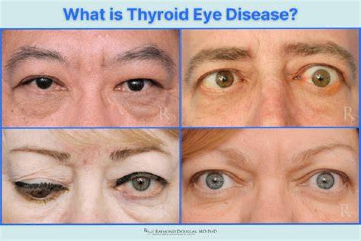 Does thyroid issues affect your eyes?