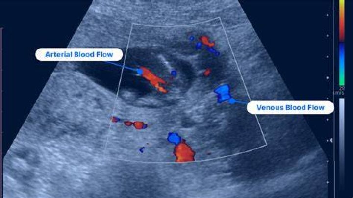 Does ultrasound have side effects?