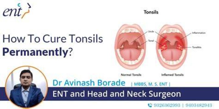 How can I permanently cure my tonsils?