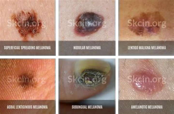 How common is scalp melanoma?
