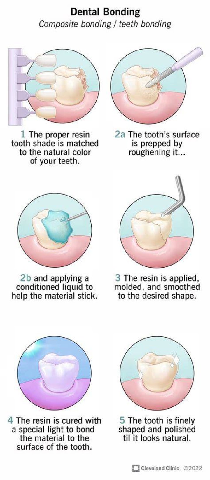 How do you brush bonded teeth?
