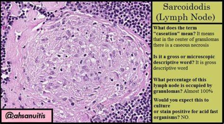 How do you know if you have sarcoidosis?