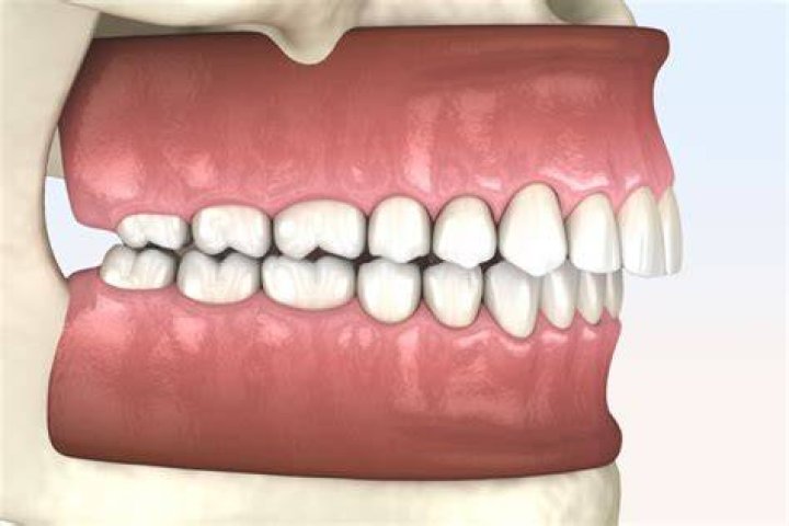 How do you know if you need a bite adjustment?