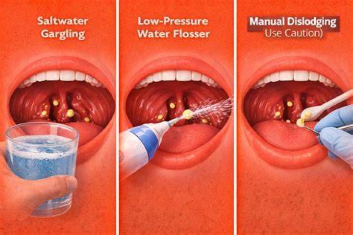 How do you treat holes in tonsil stones?