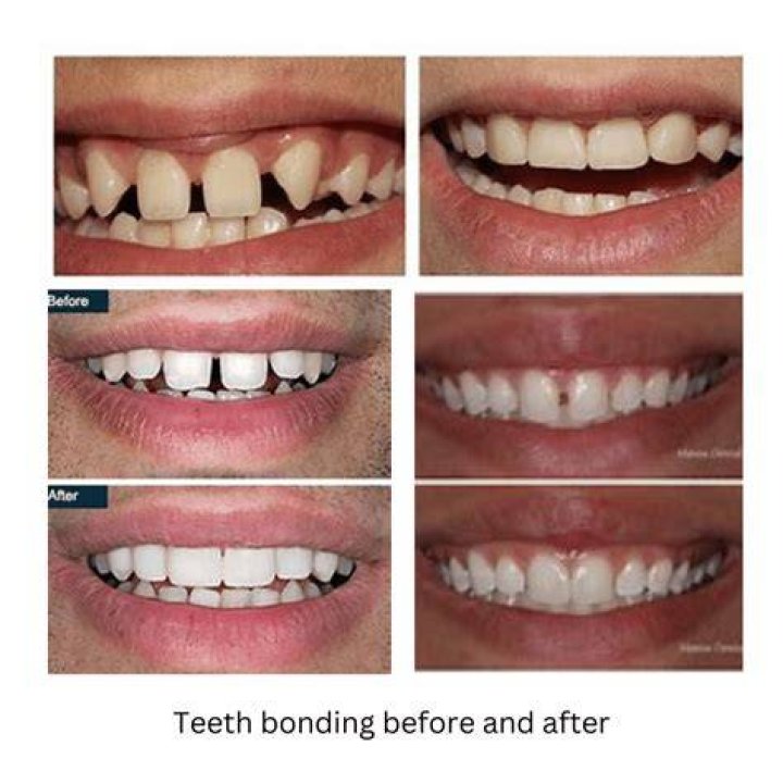 How long after teeth bonding can you eat?