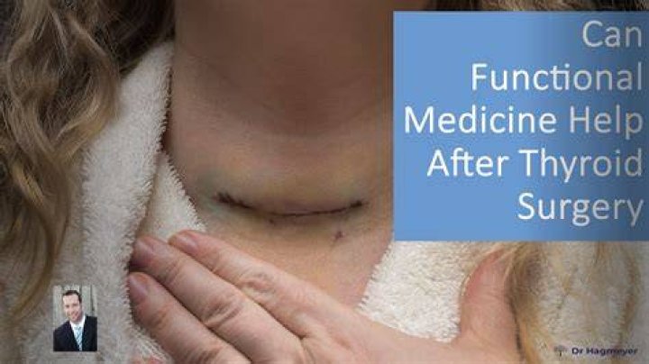 How long can you live after thyroid removed?