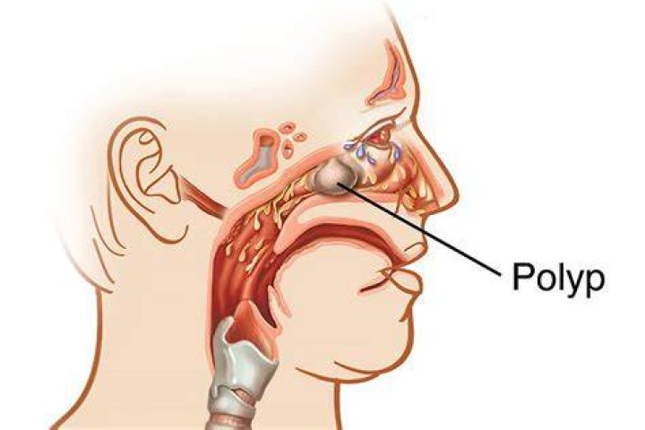 How long do you bleed after having a polyp removed?
