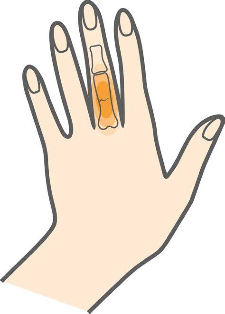 How long does a PIN stay in a broken finger?