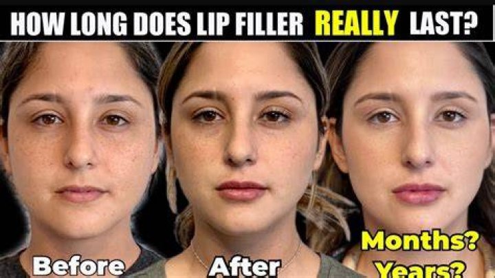 How often should you top up lip fillers?