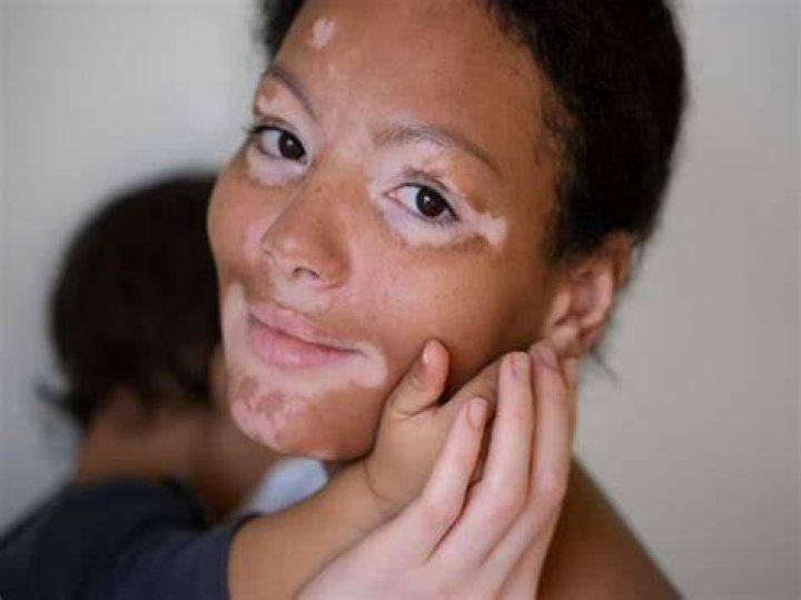 Is Almond good for vitiligo?