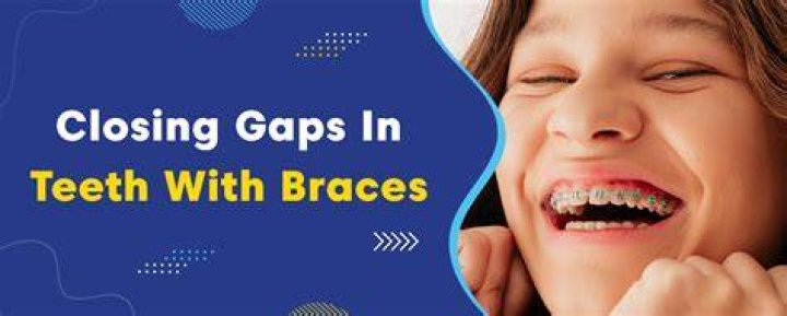 Is closing gaps last step in braces?