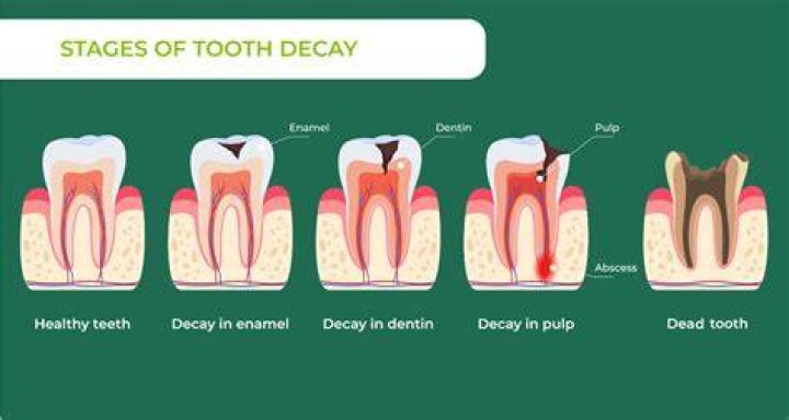 Is it a cavity if it doesn't hurt?