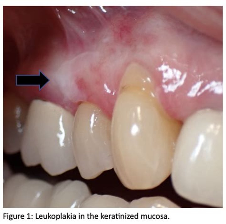 Is leukoplakia precancerous?