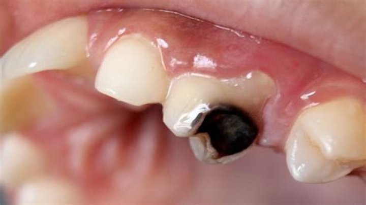 What are the black holes in my teeth?