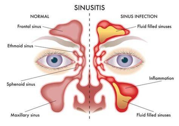 What are the symptoms of blocked sinuses?