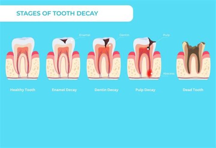 What causes root decay in teeth?