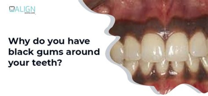 What does black gums around a tooth mean?