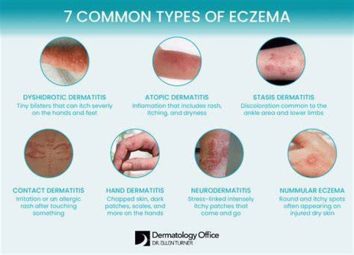 What does eczema look like on areola?