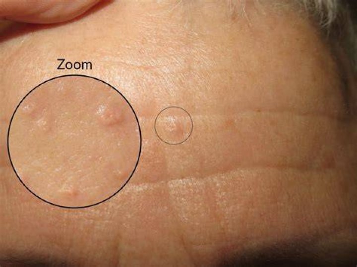 What does sebaceous hyperplasia look like?