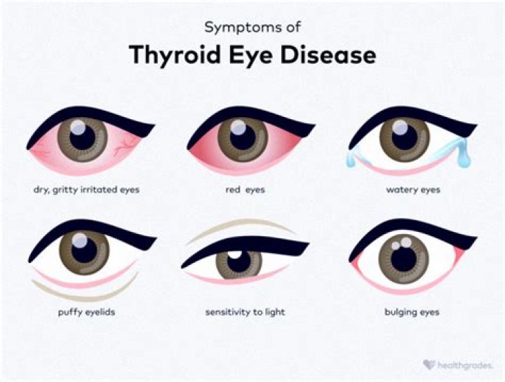 What eye condition is associated with hypothyroidism?