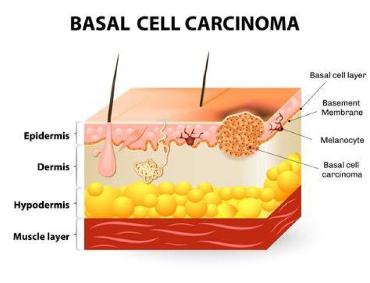 What happens if basal cell carcinoma is left untreated?