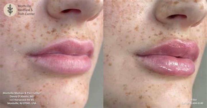 What happens if you drink from a straw after lip filler?