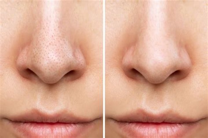 What happens to pores when blackheads are removed?