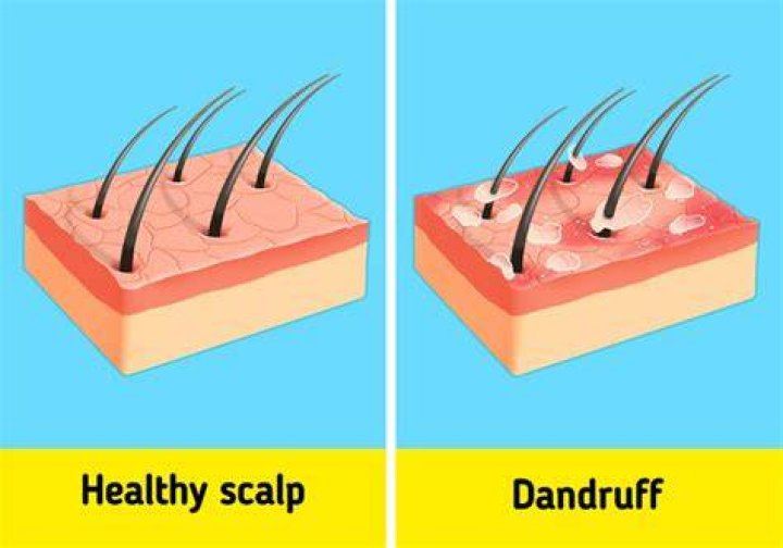 What is dandruff made of?