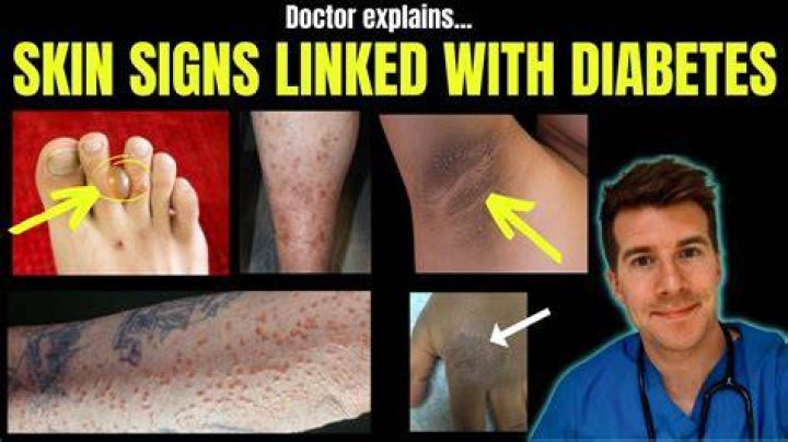 What is diabetic skin?