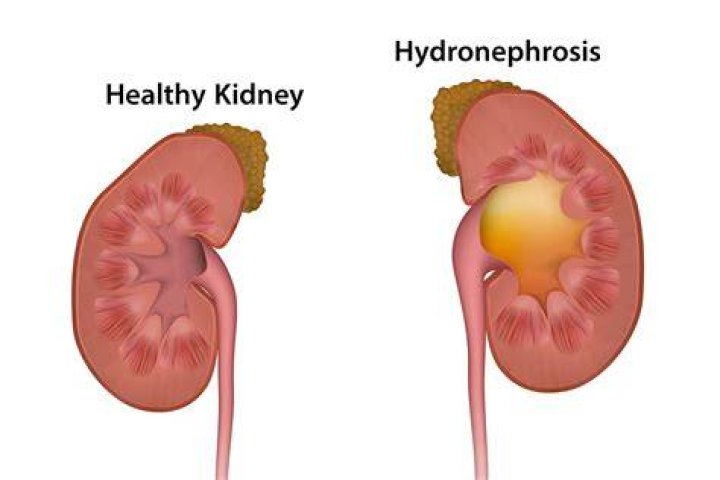 What is Hydro kidney?