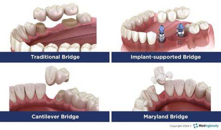 What is Minorwood in bridge?