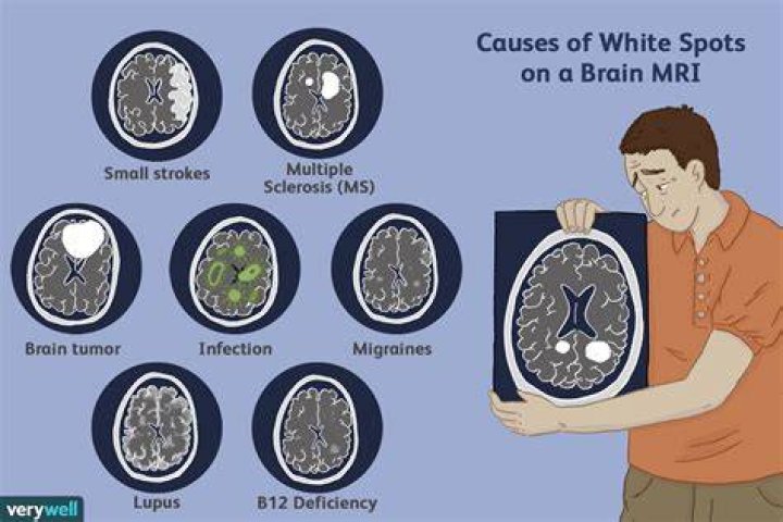 What shows up bright white on an MRI?
