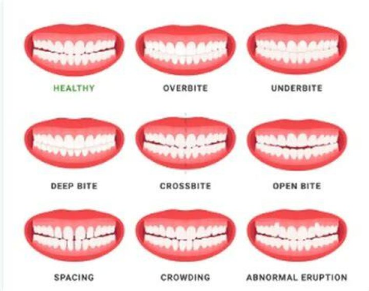 Why are crooked teeth so common?